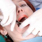 ekstrakcja zęba u kobiety przez dentystę w rękawiczkach