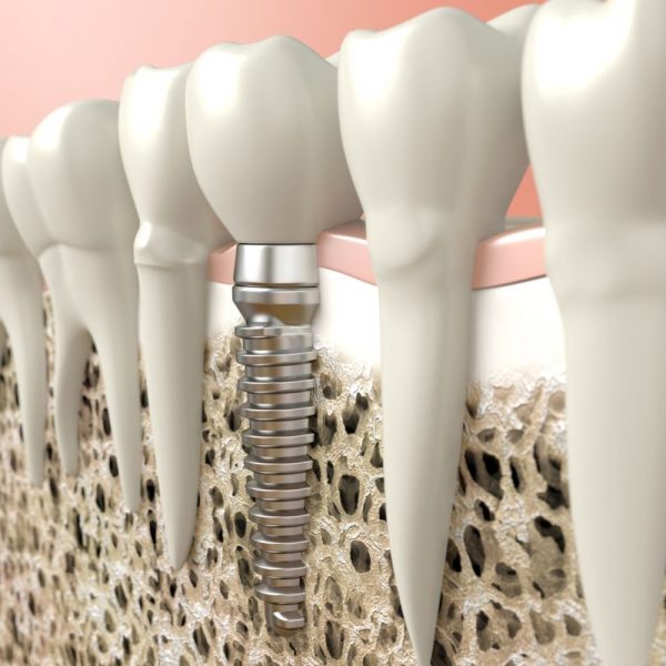 Implant dentystyczny