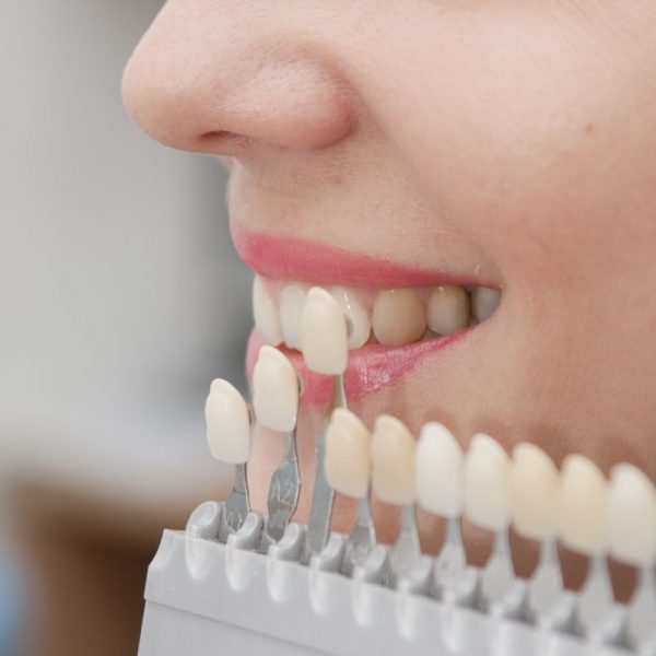 Wybielanie zębów u dentysty wybieranie licówek