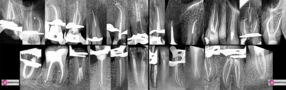 leczenie kanałowe zębów pod mikroskopem Białystok