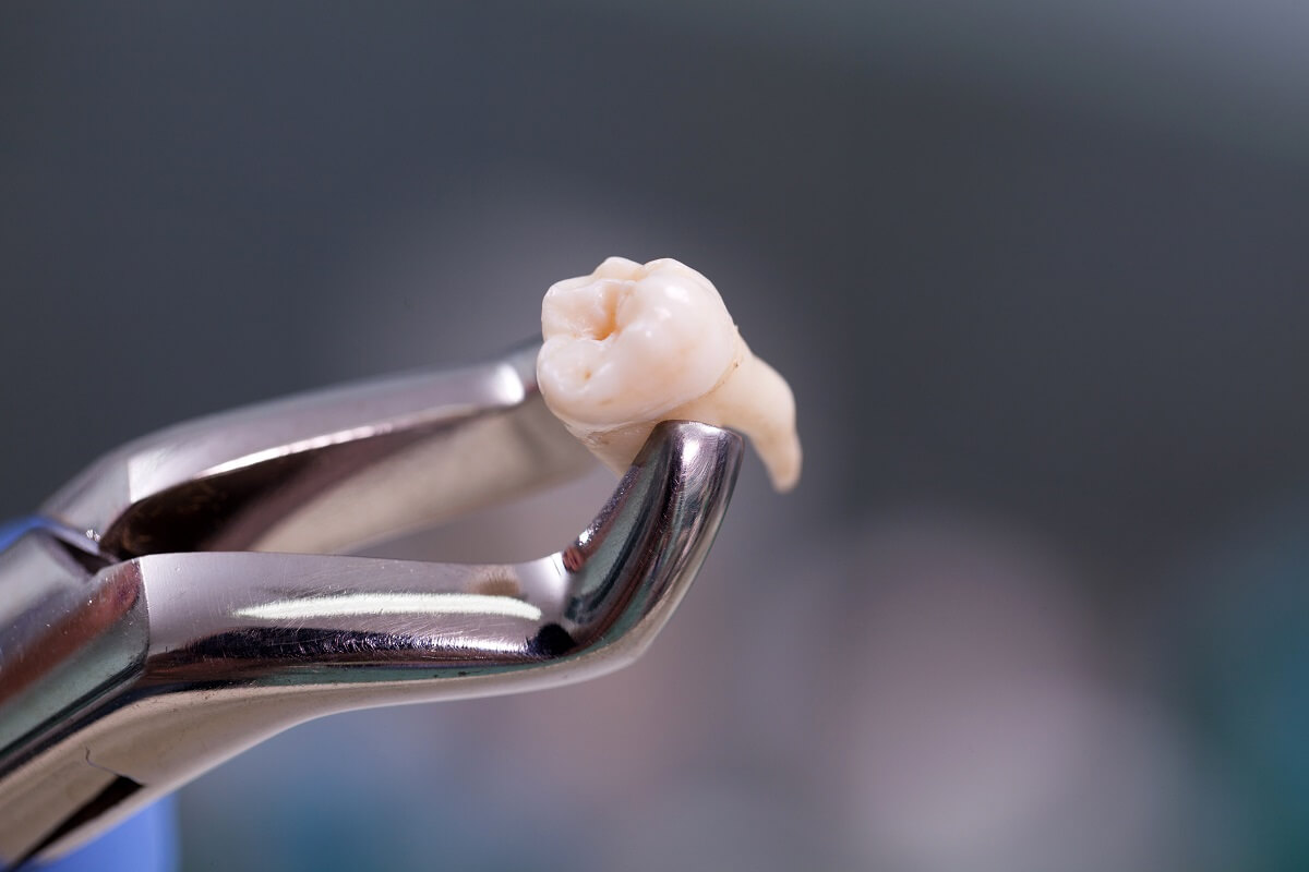 Co najlepiej wstawić po wyrwanym zębie?