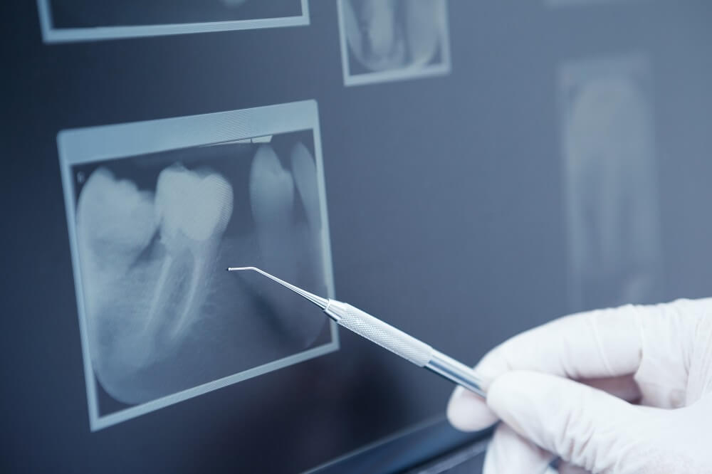 Co zrobić po leczeniu kanałowym – jak dbać o ząb i uniknąć powikłań?